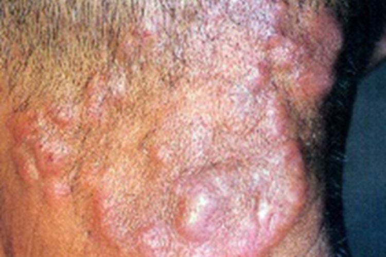 蕈样肉芽肿结节图