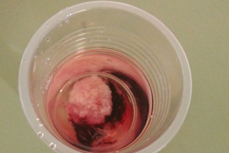 妊娠8周前自然流产肉状物图 妊娠8周前自然流产肉状物图