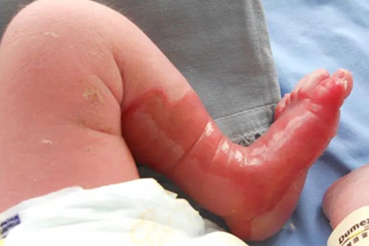 交界型大疱性表皮松解症红斑图