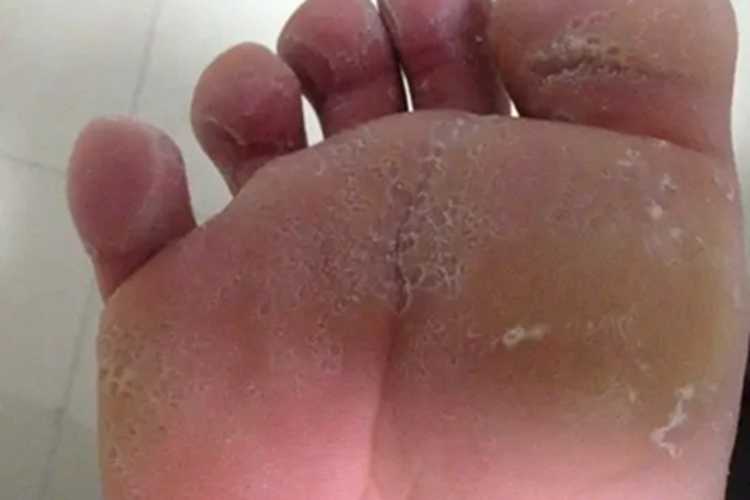 浸渍擦烂性皮炎皮肤出现小孔图 浸渍擦烂性皮炎皮肤出现小孔图