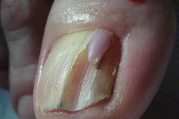 甲床黏液性囊肿图