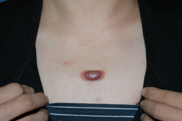 瘢痕疙瘩胸部有丘疹图 瘢痕疙瘩胸部有丘疹图