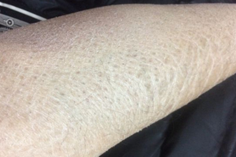 无汗症小腿干燥脱屑图 无汗症小腿干燥脱屑图