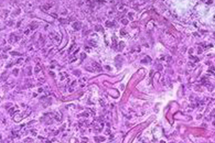 肺毛霉病病理图