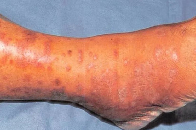 扁平苔藓脚踝丘疹图