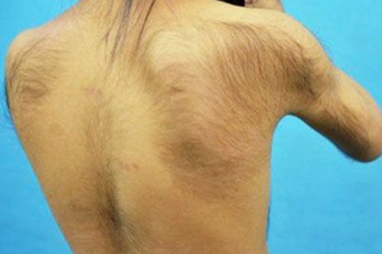 女性多毛症后背上长很多毛发图