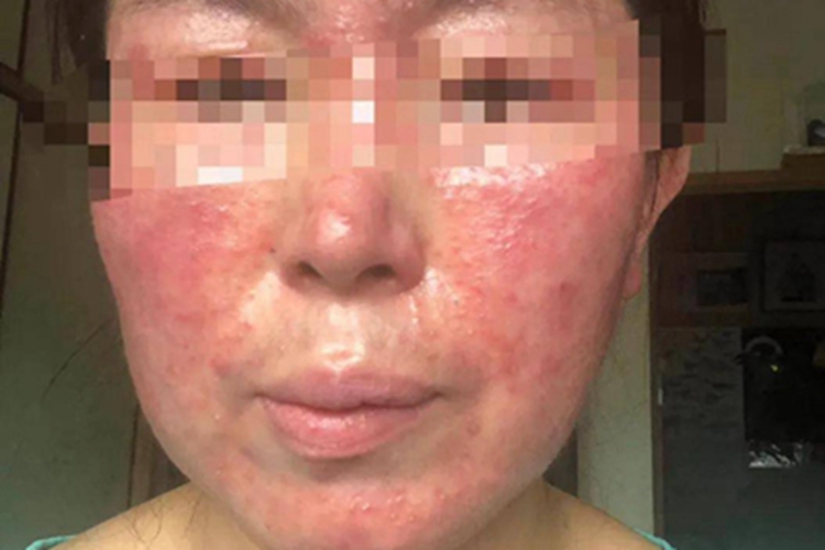 战壕热症状图 战壕热症状图