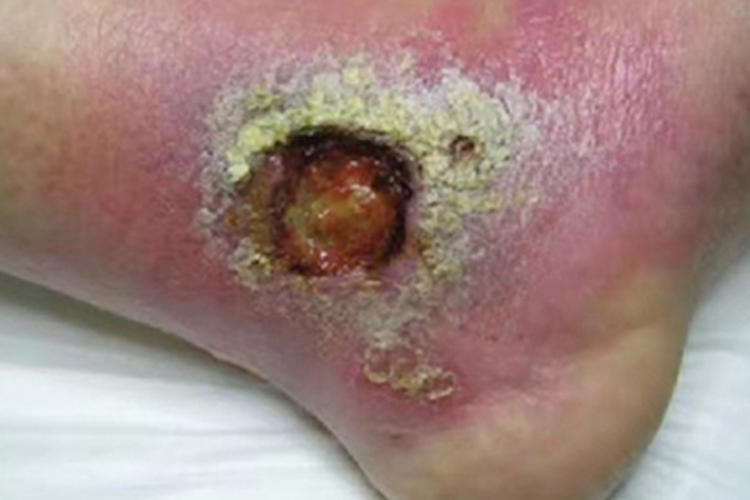 热带溃疡脚踝溃疡图