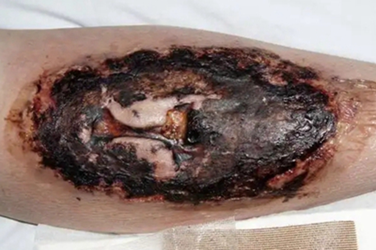 蜂窝织炎小腿溃烂发黑图