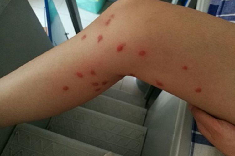 跳蚤叮咬腿部小红疙瘩图