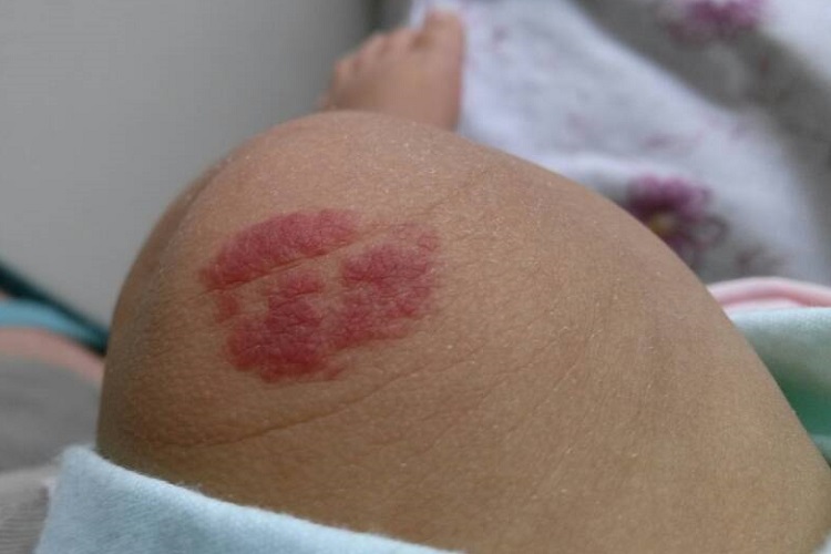 血管瘤大腿红点图