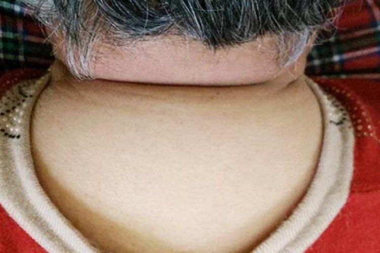 脖子后面脂肪堆积凸出来图