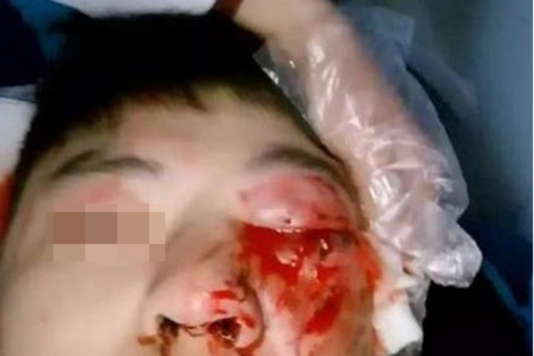 眼外伤眼睛流血图