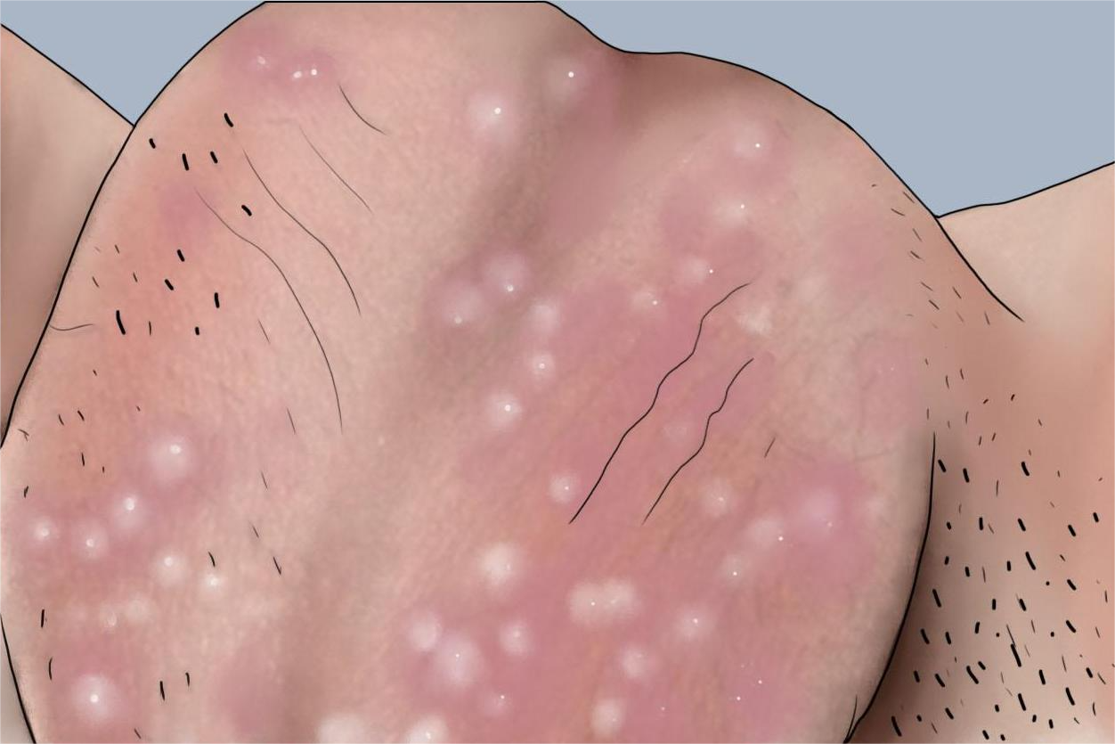 多发性皮脂腺囊肿阴囊疙瘩手绘图