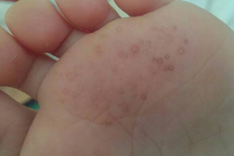 水疱型足癣图