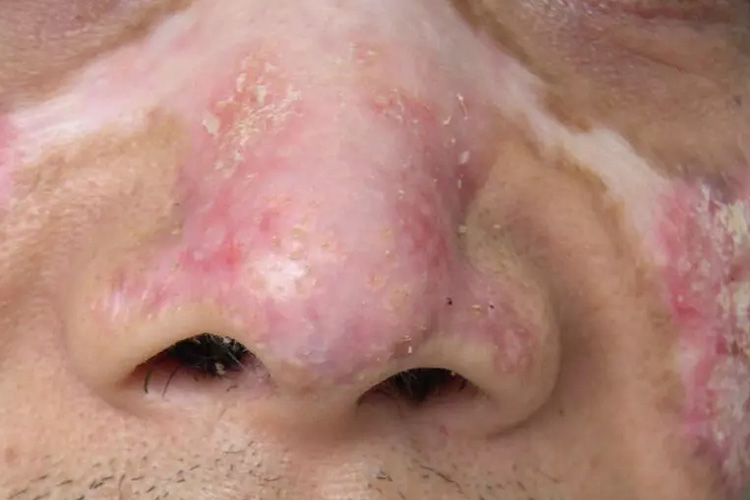 面部盘状红斑狼疮图 面部盘状红斑狼疮图