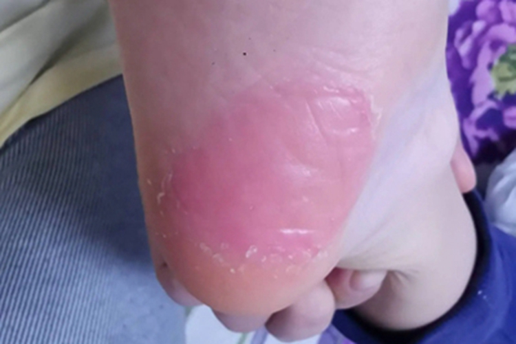 宝宝脚后跟起倒刺图