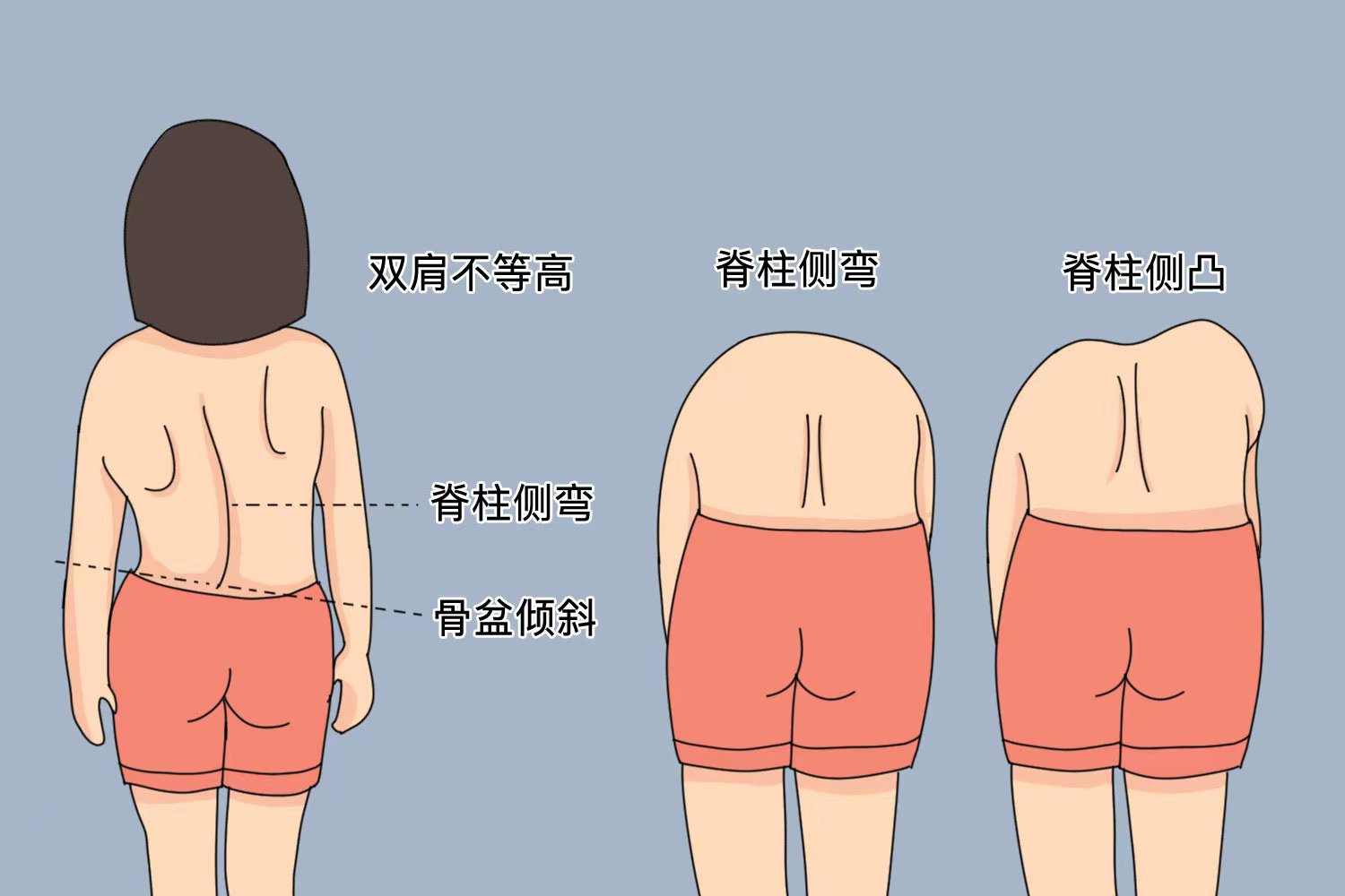 脊柱侧弯前屈位检查图