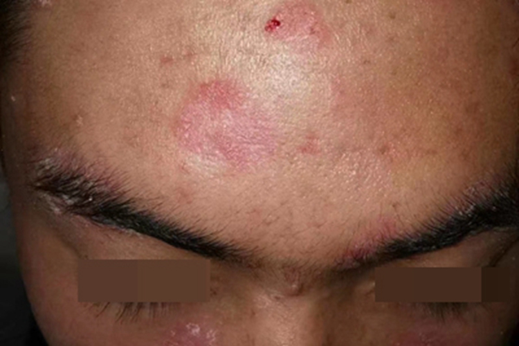 寻常型银屑病前额症状图 寻常型银屑病前额症状图