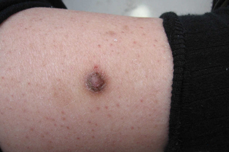 单发性有蒂软纤维瘤图