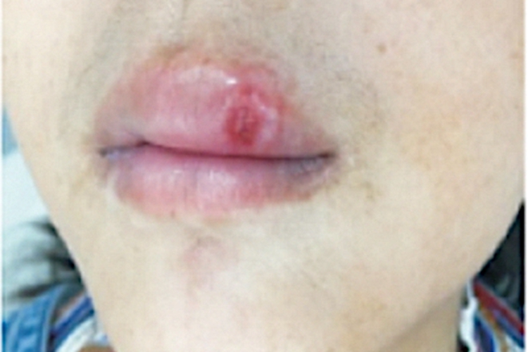 一期口腔梅毒红斑图 一期口腔梅毒红斑图