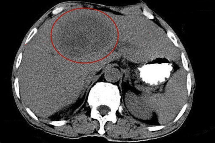 阿米巴肝脓肿CT检查图