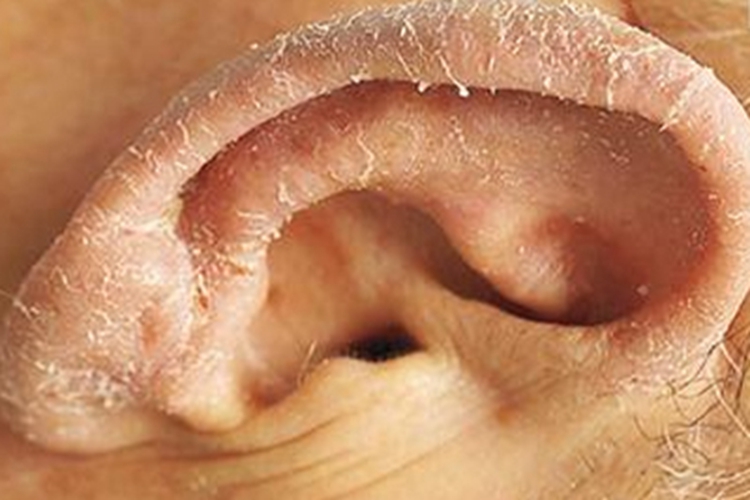 副肿瘤性肢端角化症耳廓脱皮图 副肿瘤性肢端角化症耳廓脱皮图