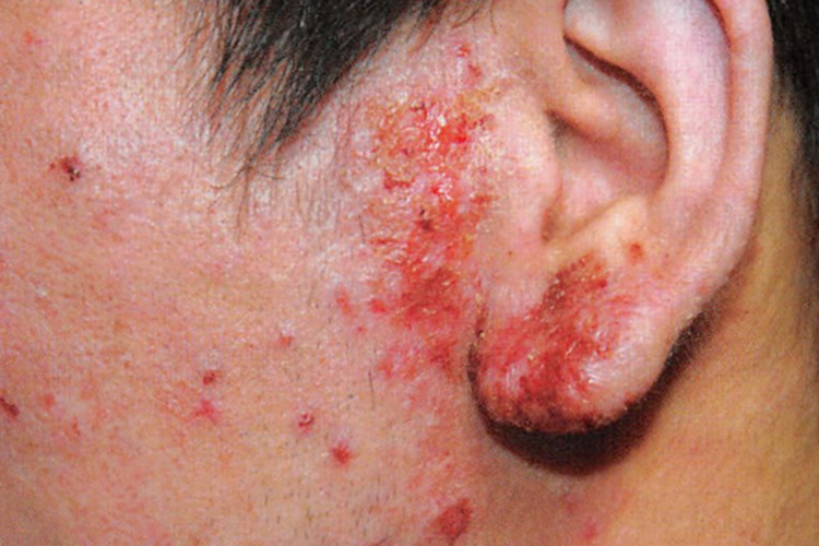 男生亚急性湿疹图