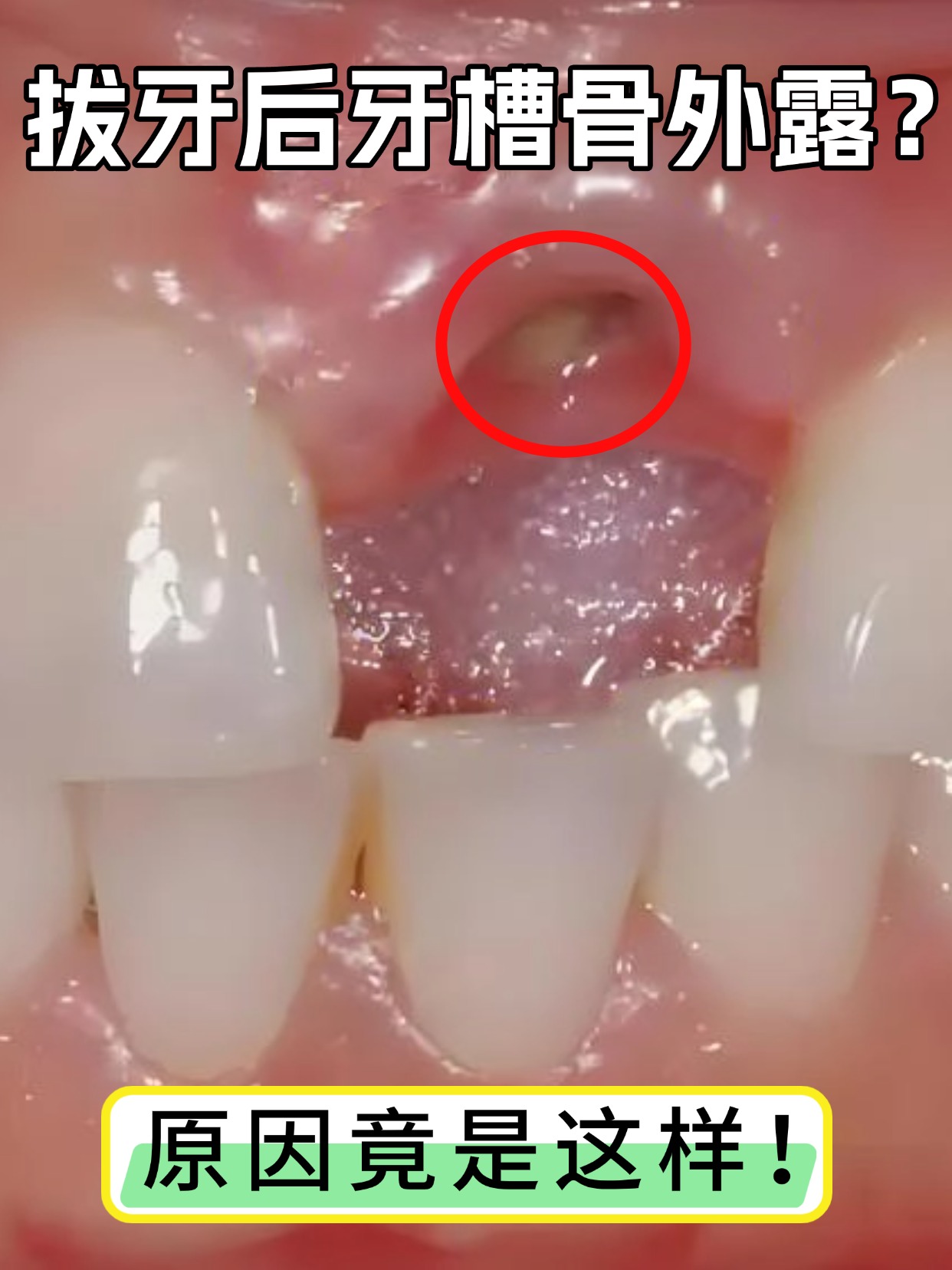 拔牙后牙槽骨外露？原因竟是这样！