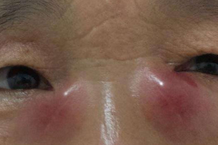 泪囊炎眼角大红疙瘩图