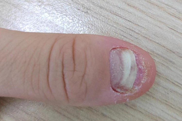 全甲损毁型甲真菌病指甲缺损图 全甲损毁型甲真菌病指甲缺损图