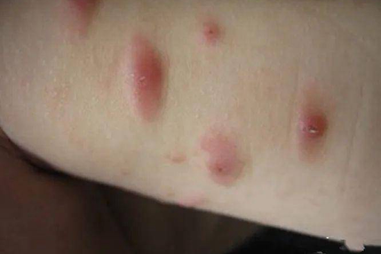 虫咬性皮炎:可出现自觉刺痛,灼痛,奇痒,一般无全身症状