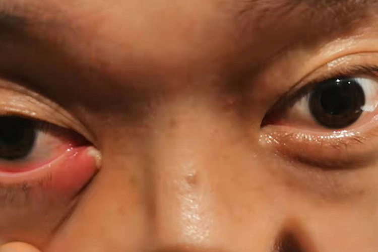 眼角内睑板腺囊肿有小肉疙瘩图
