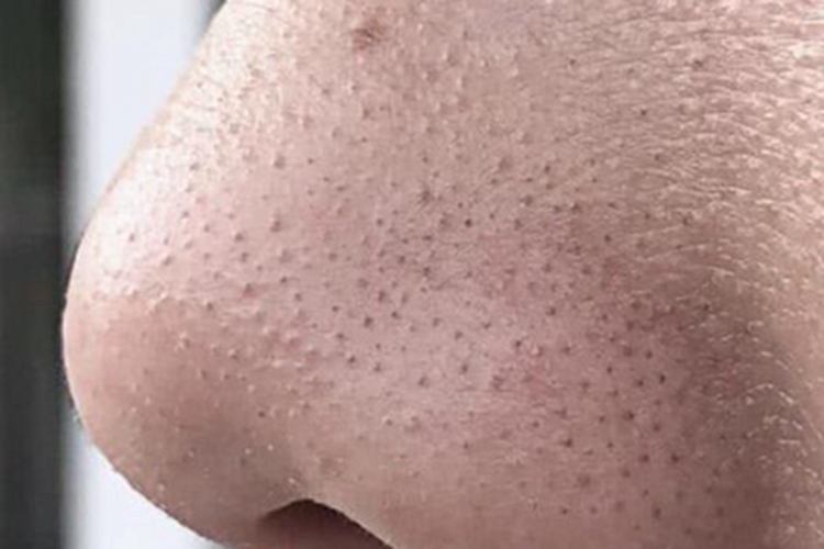 黑头鼻翼很多小黑点图