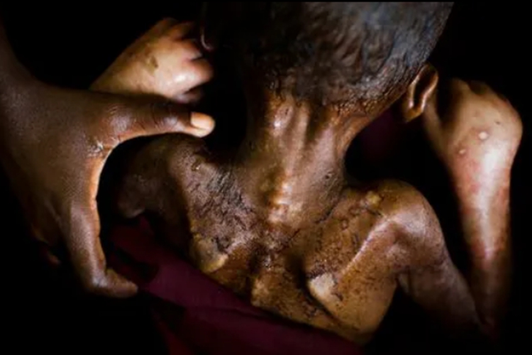 营养不良肩胛图