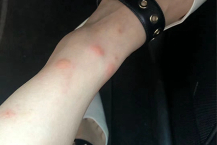 跳蚤叮咬症状图