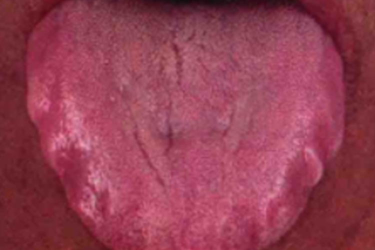 齿痕舌图 齿痕舌图