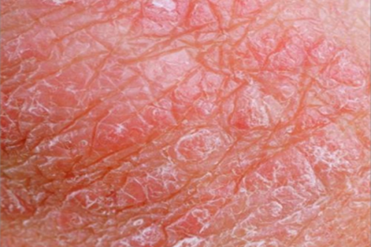 阴囊湿疹亚急性期阴囊丘疹图