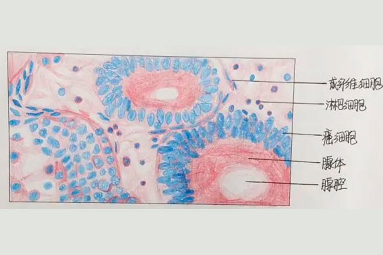 结肠腺癌病理红蓝铅笔手绘图 结肠腺癌病理红蓝铅笔手绘图