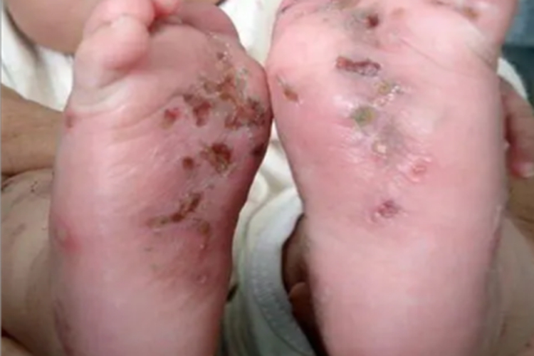 结痂性疥疮脚底症状图