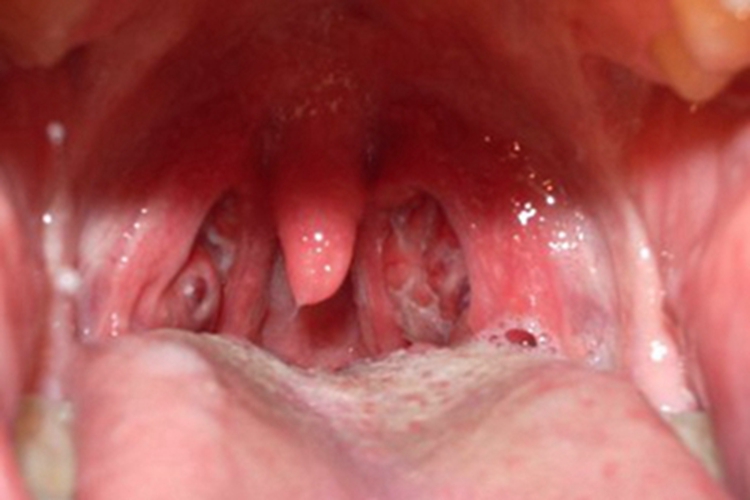 慢性咽炎红肿图