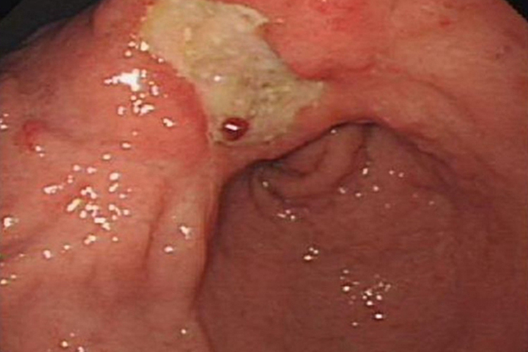 胃黏膜糜烂出血图 胃黏膜糜烂出血图