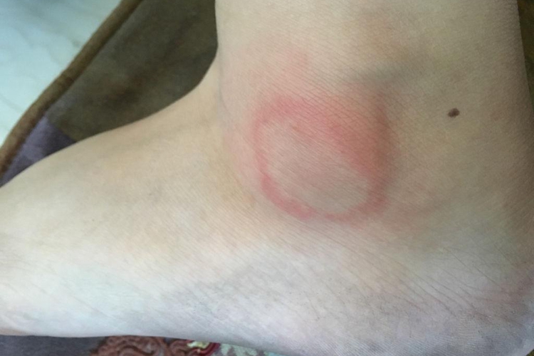 接触性皮炎脚踝一圈发红图