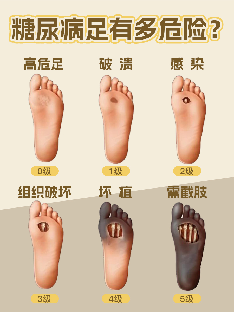 警惕！糖尿病足这些症状一出现，脚可能要“遭殃”