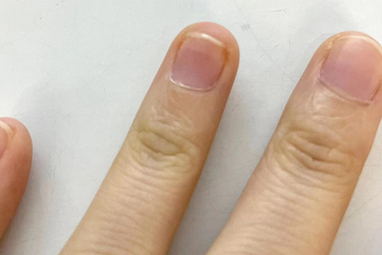手指拔甲后恢复正常图