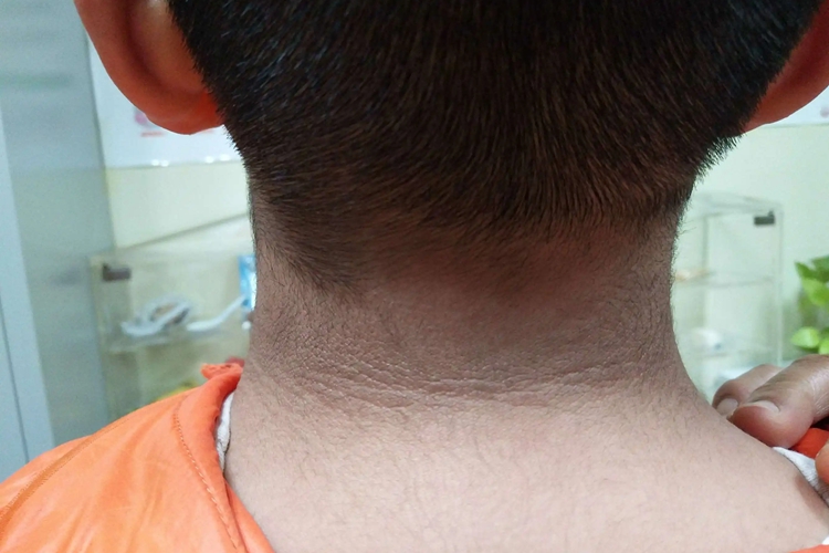 小孩脖子黑棘皮病图