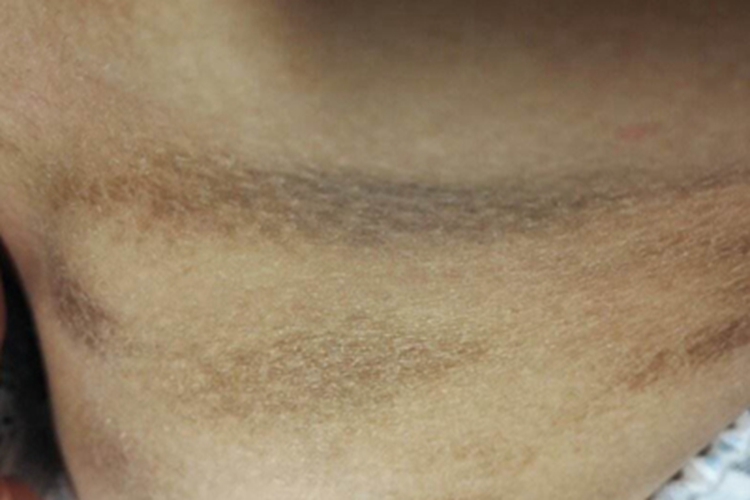 血管萎缩性皮肤异色病颈部症状图 血管萎缩性皮肤异色病颈部症状图