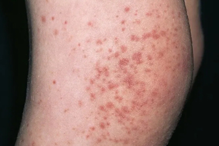 小儿过敏性紫癜膝盖丘疹图 小儿过敏性紫癜膝盖丘疹图