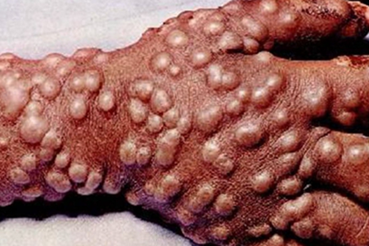 天花手背长满豆大的水疱图