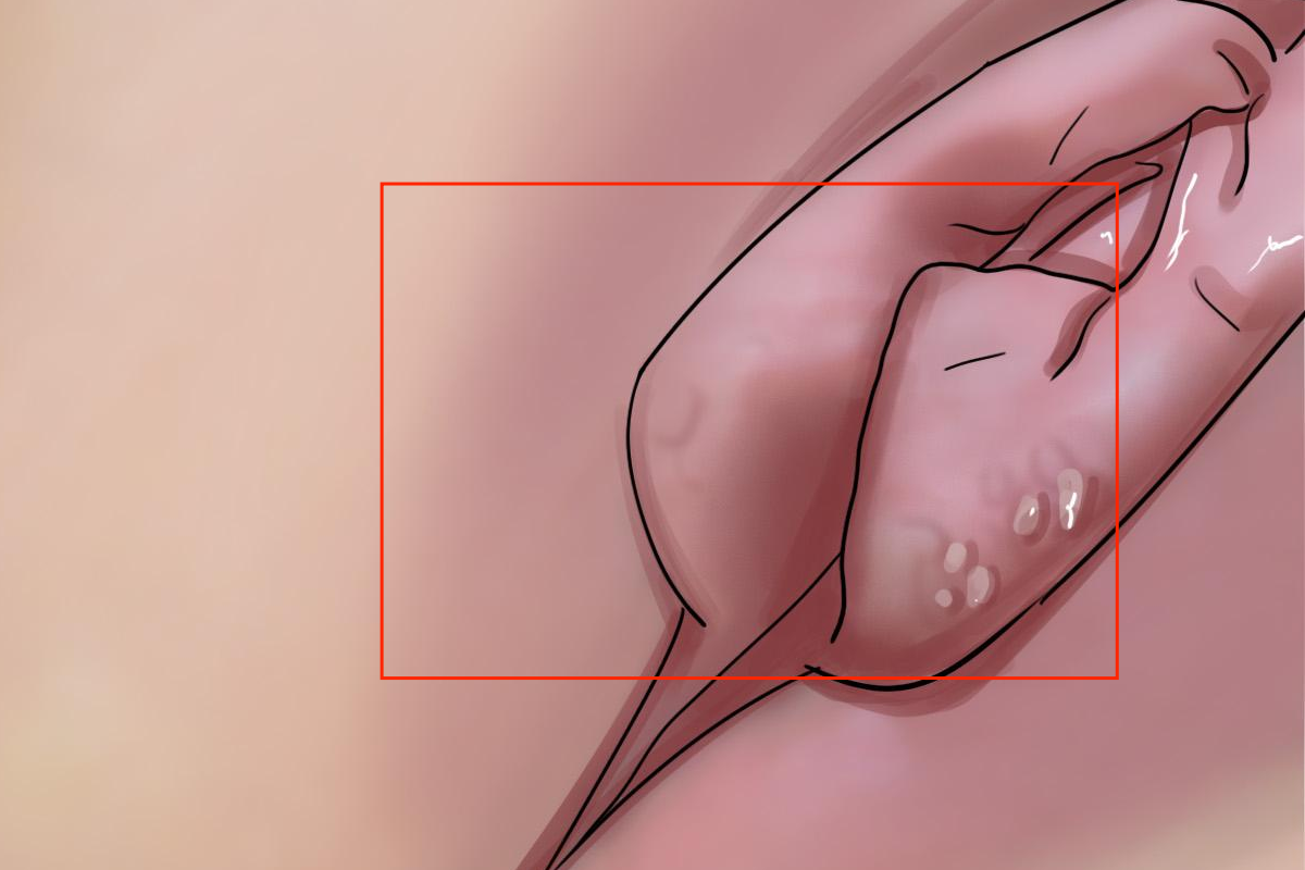 女性外阴湿疹图